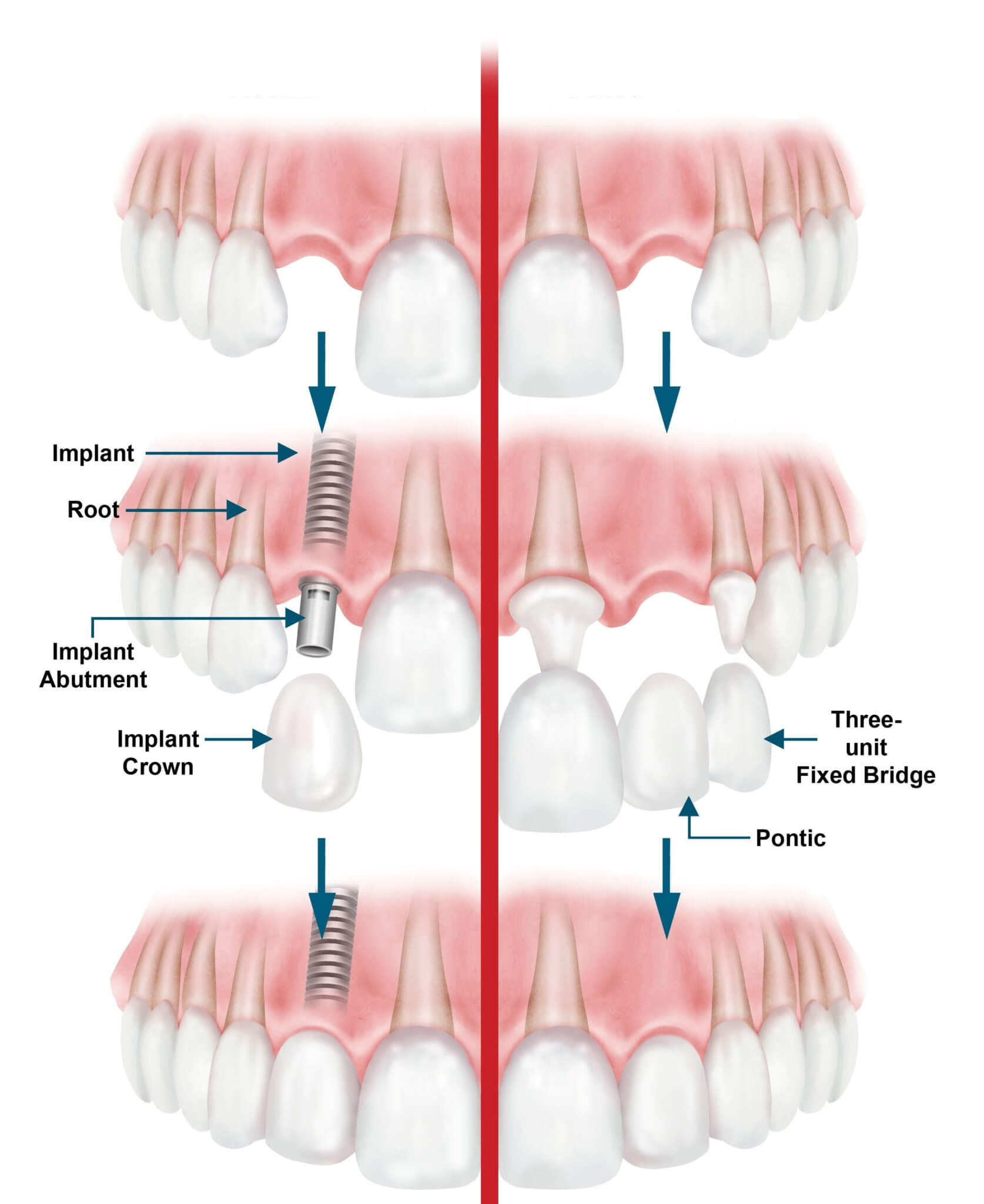 Dental Implants Abroad Cost £400 in Romania Omnia Dental Clinic