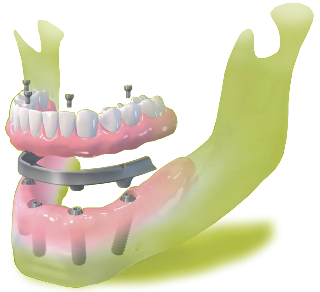 all on four dental implants Straumann